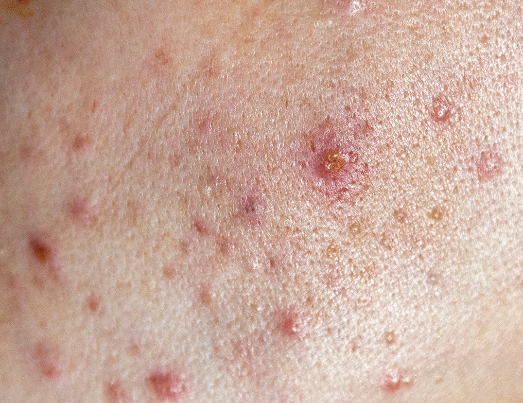 Acne-Prone