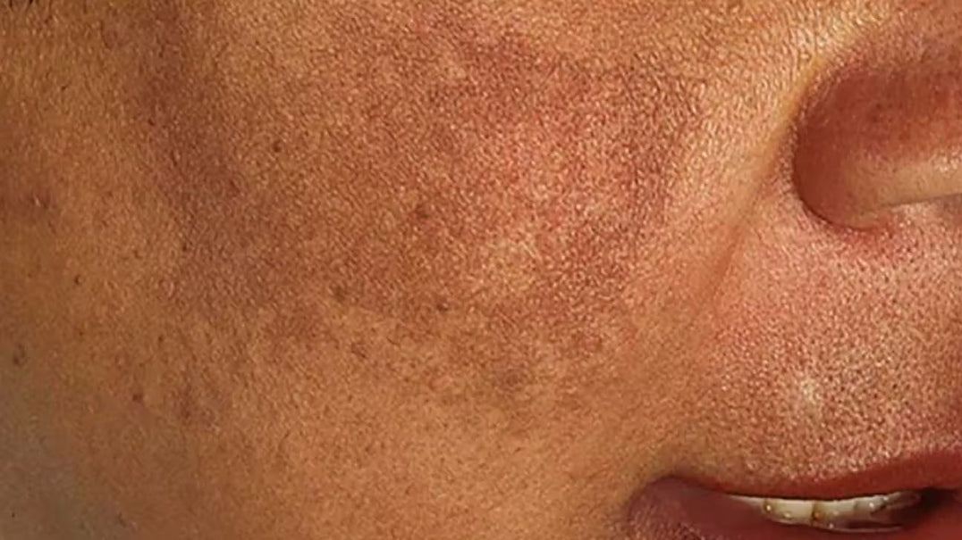 Melasma