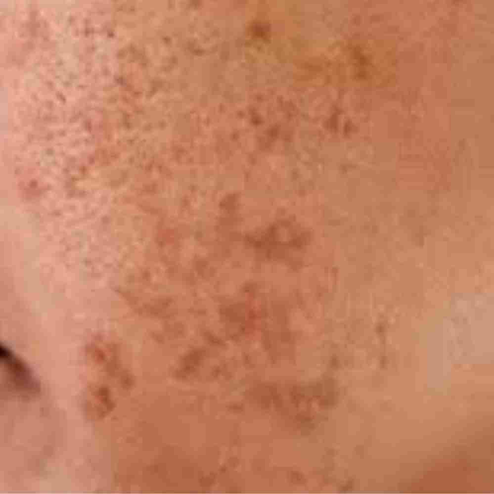 Melasma